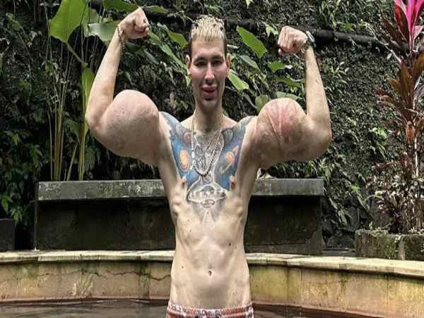 Vụ việc gây sốc - VĐV thể hình Nga có nguy cơ bị cắt bỏ hai tay vì tiêm chất tăng cơ trái phép